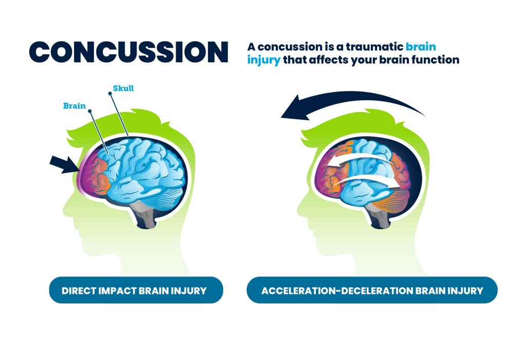 Concussions | Complete Care Centers